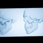 Facial contouring surgery