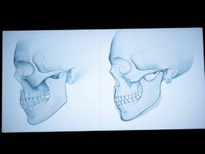 Facial contouring surgery